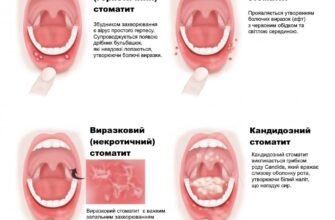 Причини стоматиту: що викликає запалення слизової оболонки рота?