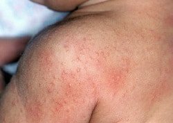 Захворювання в дерматології – лікування в Кривому Розі