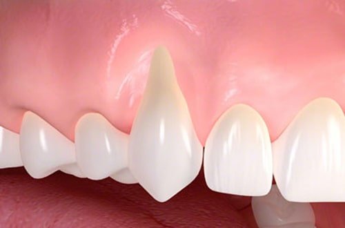 Рецесія ясен - чому опускаються ясна? | SILK