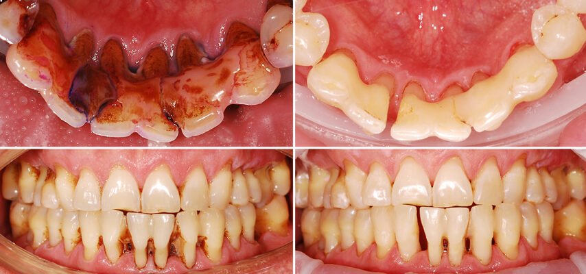 Причини та рішення: що робити, якщо ясна відійшли від зуба?