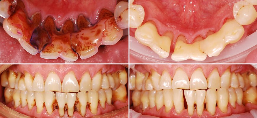 Причини та рішення: що робити, якщо ясна відійшли від зуба?