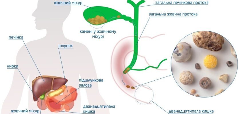 Причини утворення каменів у жовчному міхурі: основні фактори ризику