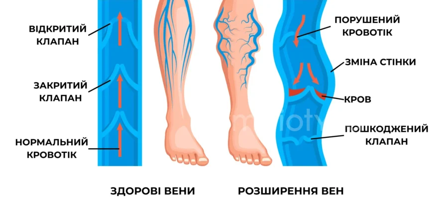 Причини варикозу: основні фактори, які впливають на розвиток хвороби