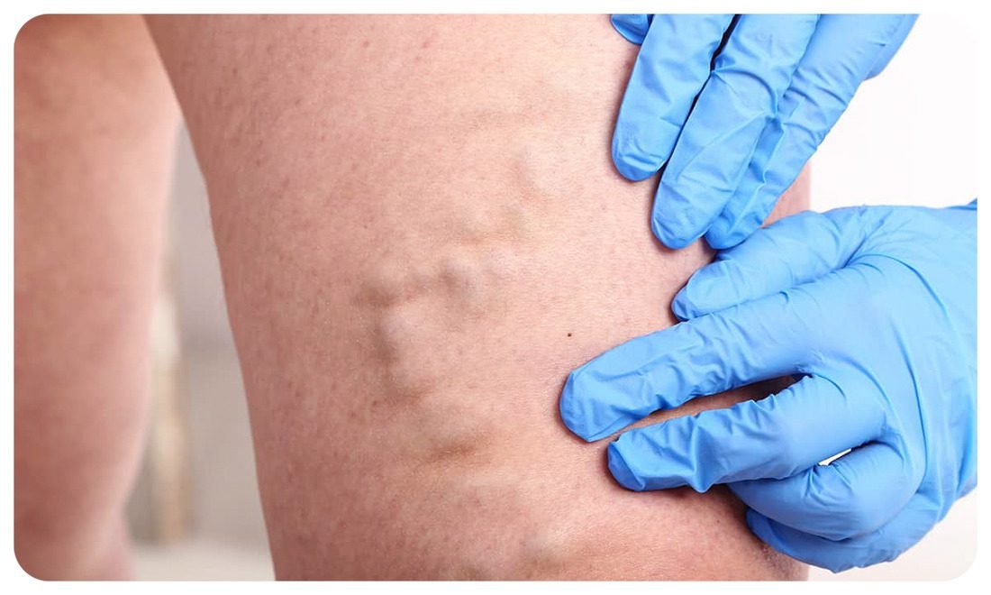 Як уникнути рецидиву варикозу після лікування