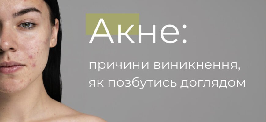 Причини виникнення акне: основні фактори, що спричиняють висипання