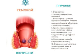 Причини виникнення геморою: від чого залежить ваше здоров’я?