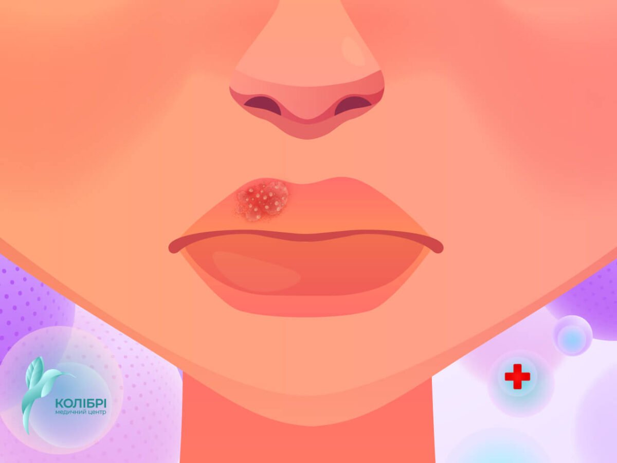 Чому виникає герпес на губах та як його позбутися ...
