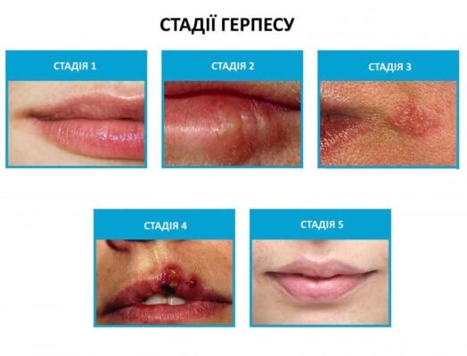 Причини виникнення герпесу на губах: основні чинники та профілактика