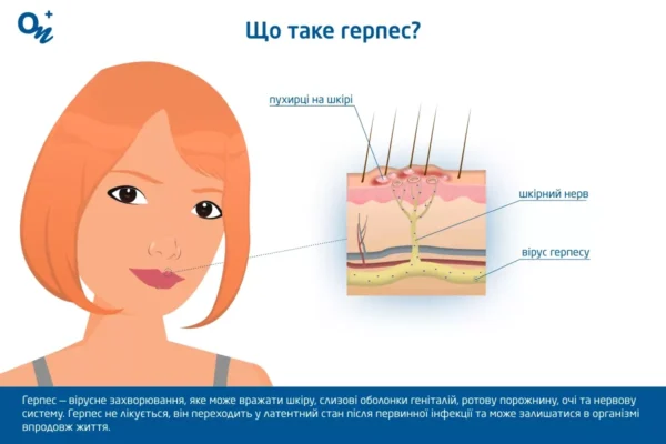 Причини виникнення герпесу на тілі: основні фактори та ризики Причини виникнення герпесу на тілі: основні фактори та ризики