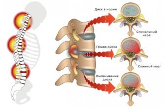 Причини виникнення грижі: основні фактори та профілактика