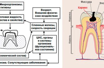 Причини виникнення карієсу: основні фактори та профілактика