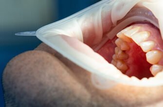 Причини виникнення карієсу: від яких чинників залежить здоров’я зубів?