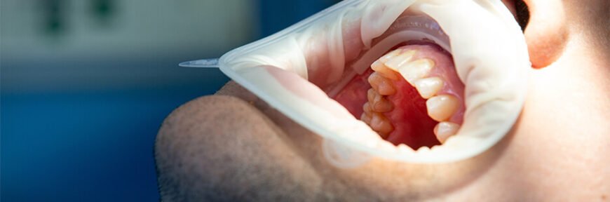 Причини виникнення карієсу: від яких чинників залежить здоров’я зубів? Причини виникнення карієсу: від яких чинників залежить здоров’я зубів?