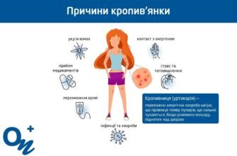 Причини виникнення кропив’янки: що викликає цю шкірну реакцію?