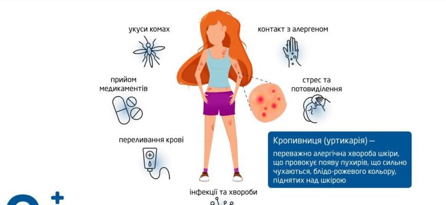 Причини виникнення кропив’янки: що викликає цю шкірну реакцію?