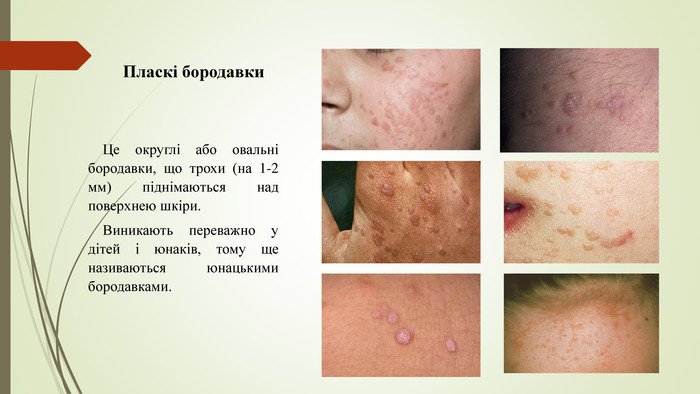 Що таке папіломи та як їх лікувати?