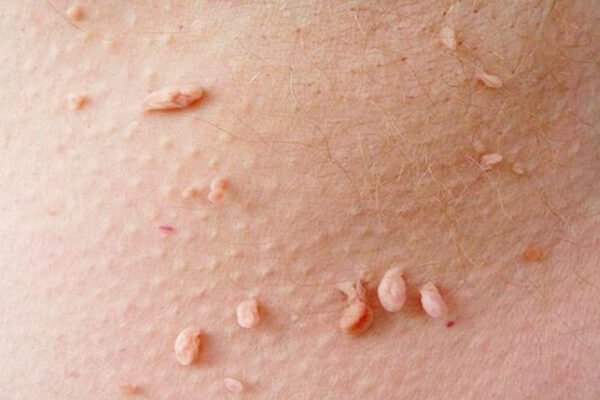 Причини виникнення папілом: основні фактори та шляхи зараження Причини виникнення папілом: основні фактори та шляхи зараження