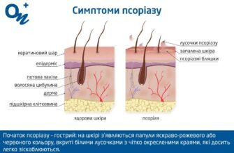 Причини виникнення псоріазу: основні фактори та їх вплив на шкіру