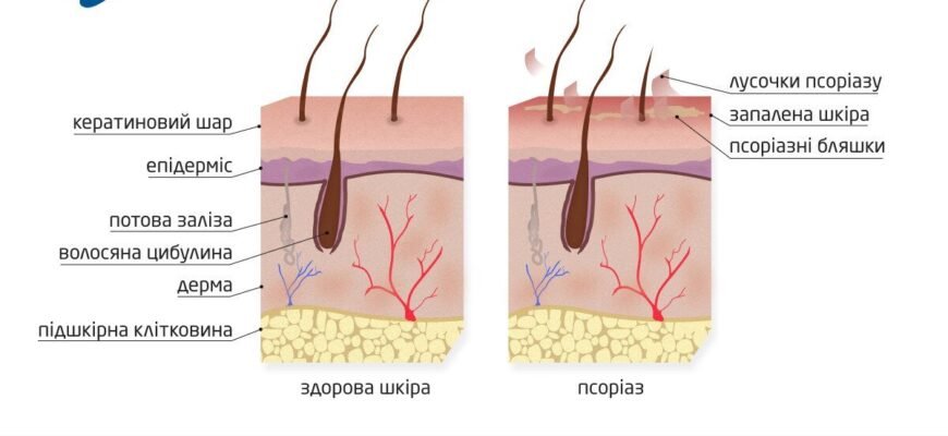 Причини виникнення псоріазу: основні фактори та їх вплив на шкіру