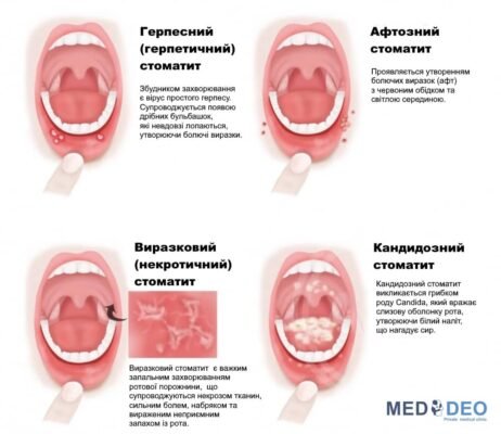 Причини виникнення стоматиту: основні фактори та методи запобігання