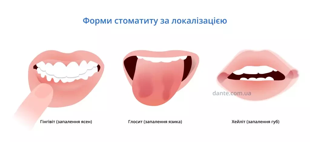 Стоматит у дітей: як розпізнати, види, лікування — D.Ante