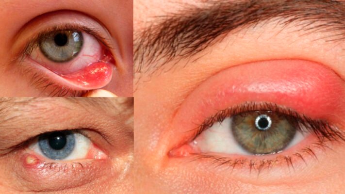 Причини виникнення ячменю на оці: основні фактори та профілактика