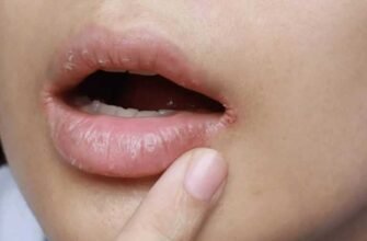 Причини виникнення заїд: що спричиняє тріщини в куточках губ?