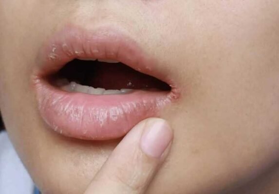 Причини виникнення заїд: що спричиняє тріщини в куточках губ?
