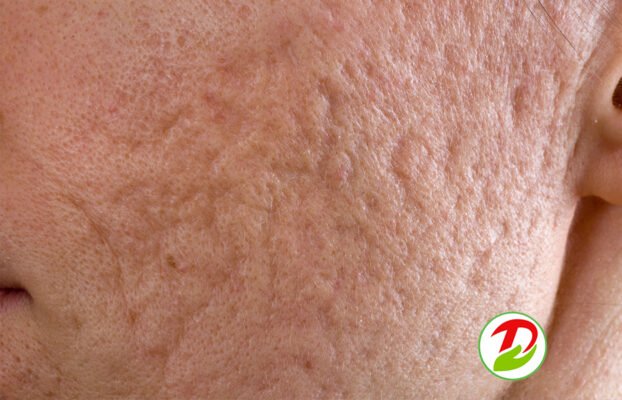 Рубці від акне: ефективні методи лікування та профілактики шрамів