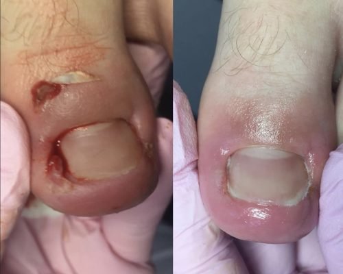 Врослий ніготь на нозі, що робити? Поради подолога