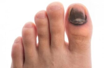 Що робити, якщо палець на нозі посинів через удар: перша допомога та поради