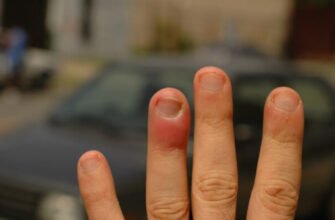 Що робити, якщо після удару опух палець: ефективні поради та лікування