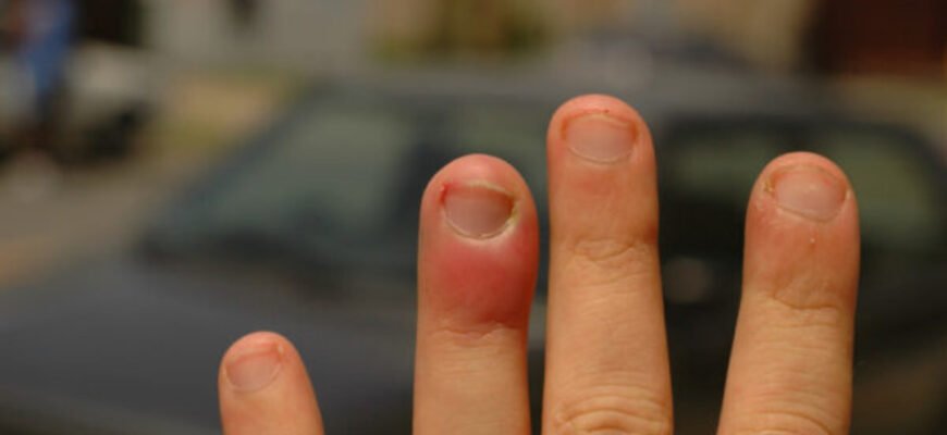 Що робити, якщо після удару опух палець: ефективні поради та лікування