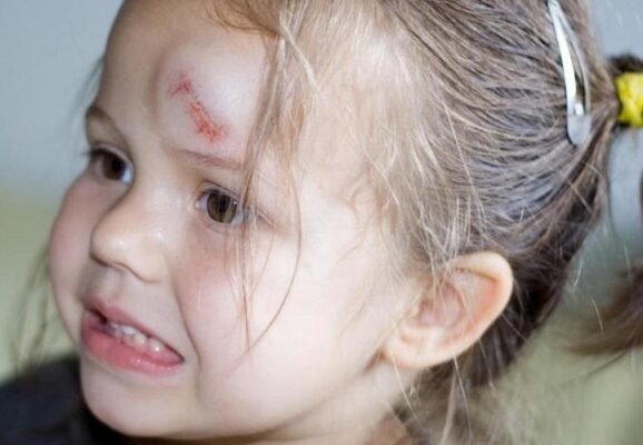 Шишка на голові у дитини від удару: що робити та як допомогти?