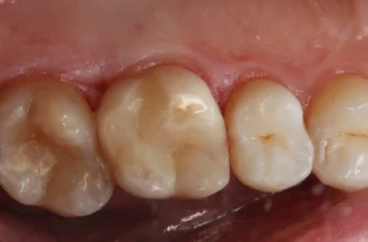 Ціни на чистку зубів від карієсу: що потрібно знати в 2023 році