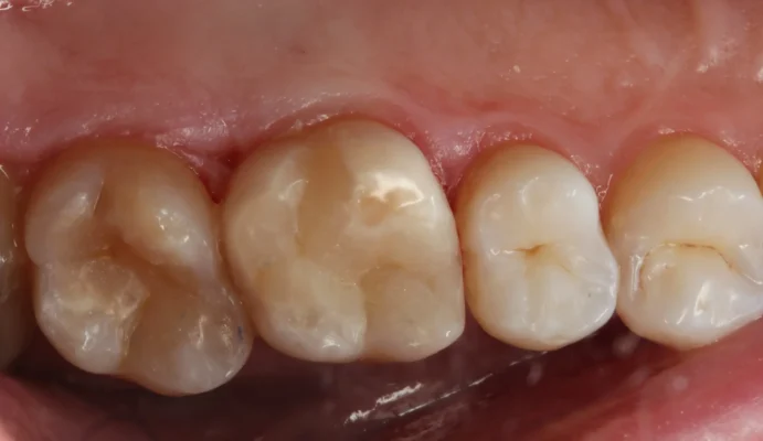 Ціни на чистку зубів від карієсу: що потрібно знати в 2023 році Ціни на чистку зубів від карієсу: що потрібно знати в 2023 році