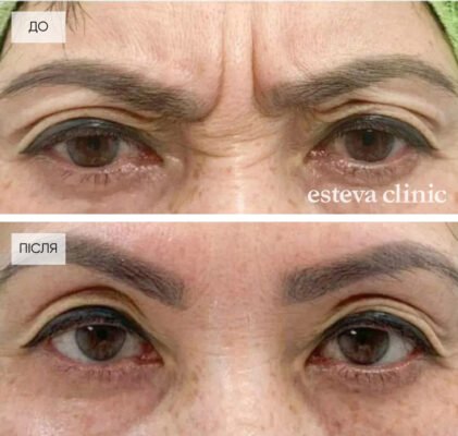 Ціни на ін’єкції від зморшок: актуальні пропозиції та поради експертів