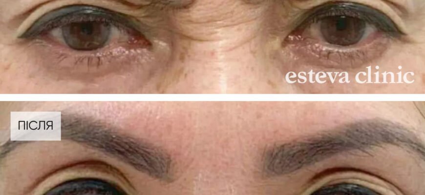 Ціни на ін’єкції від зморшок: актуальні пропозиції та поради експертів