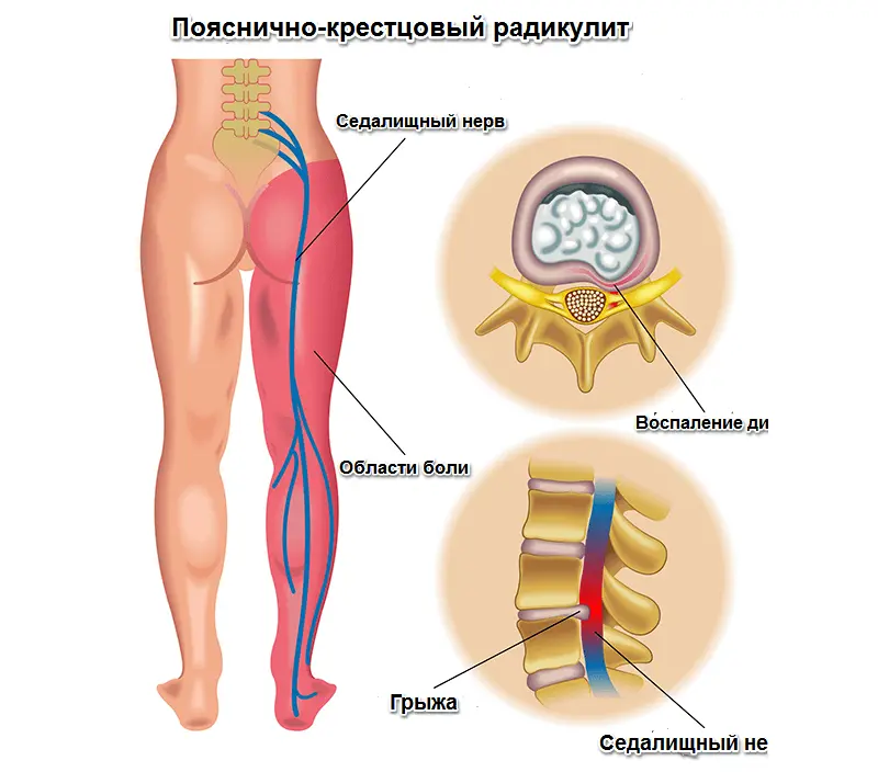 Біль у попереку - Причини чому болить поперек - Лікування в Києві