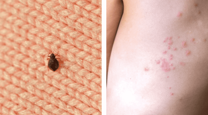 Усе про укуси клопів: як розпізнати та уникнути небезпеки