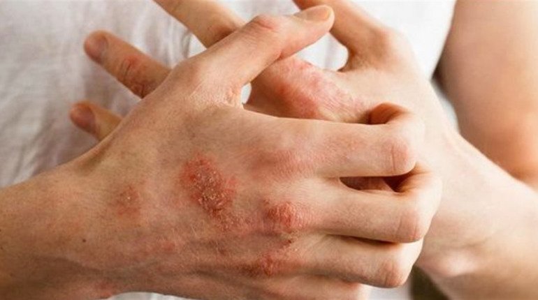 Висип внаслідок стресу: діагностика та лікування – Нетішин.City