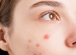 Прищі на обличчі – лікування у Кривому Розі, дерматологія