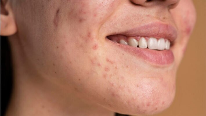 Висипи на обличчі: як печінка впливає на стан шкіри та що робити?