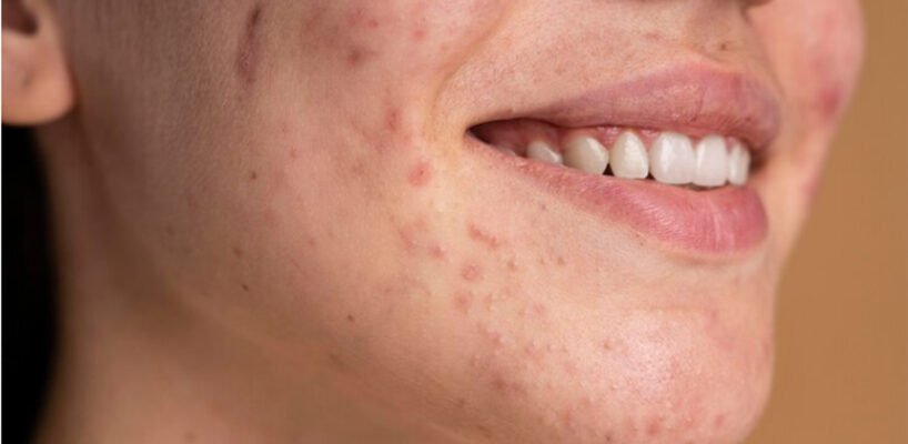 Висипи на обличчі: як печінка впливає на стан шкіри та що робити?