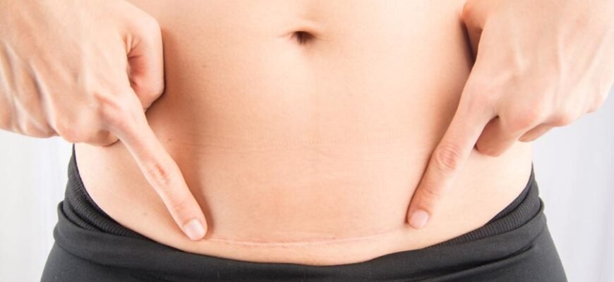 Як доглядати за шрамом після кесаревого розтину: поради та рекомендації