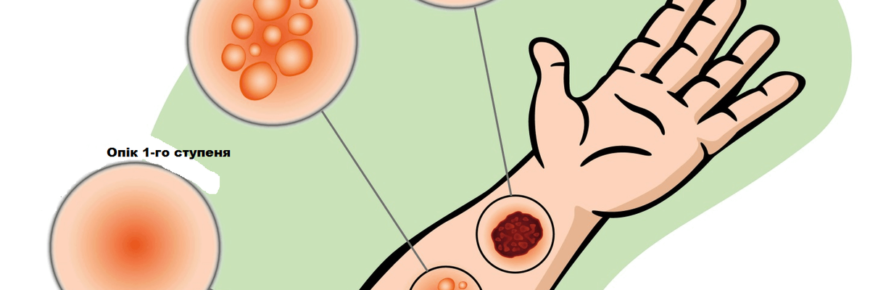 Як ефективно лікувати опіки від окропу: перевірені методи та засоби