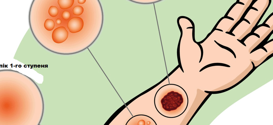 Як ефективно лікувати опіки від окропу: перевірені методи та засоби