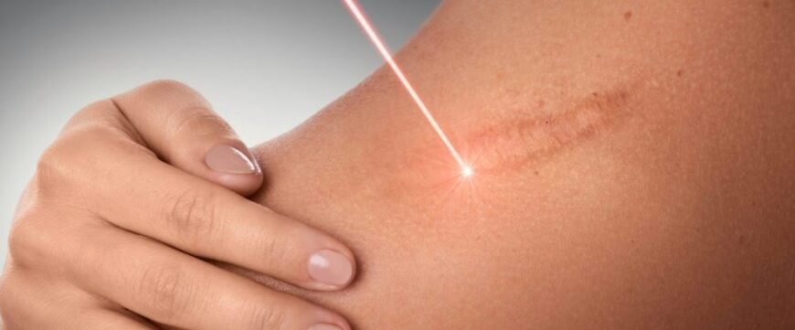 Як ефективно лікувати шрами від опіків: найкращі методи та поради