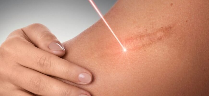 Як ефективно лікувати шрами від опіків: найкращі методи та поради