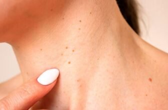 Як ефективно позбутися папілом на шиї: рекомендації та засоби